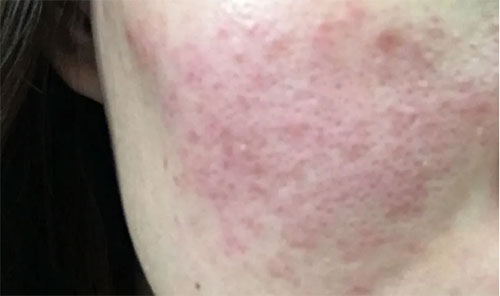 皮膚泛紅癢是什么原因？皮膚紅癢怎么回事？