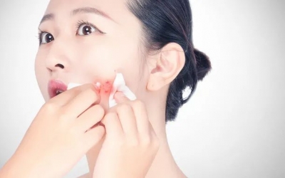 如何預(yù)防粉刺的發(fā)生和痤瘡的形成？