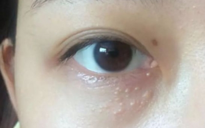 為什么眼部容易長脂肪粒？