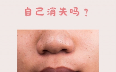 什么是黑頭？怎樣預防黑頭的形成？